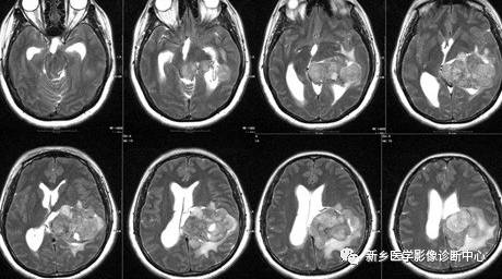 常见但不简单，这15种脑膜瘤你能诊断吗？