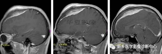 常见但不简单，这15种脑膜瘤你能诊断吗？