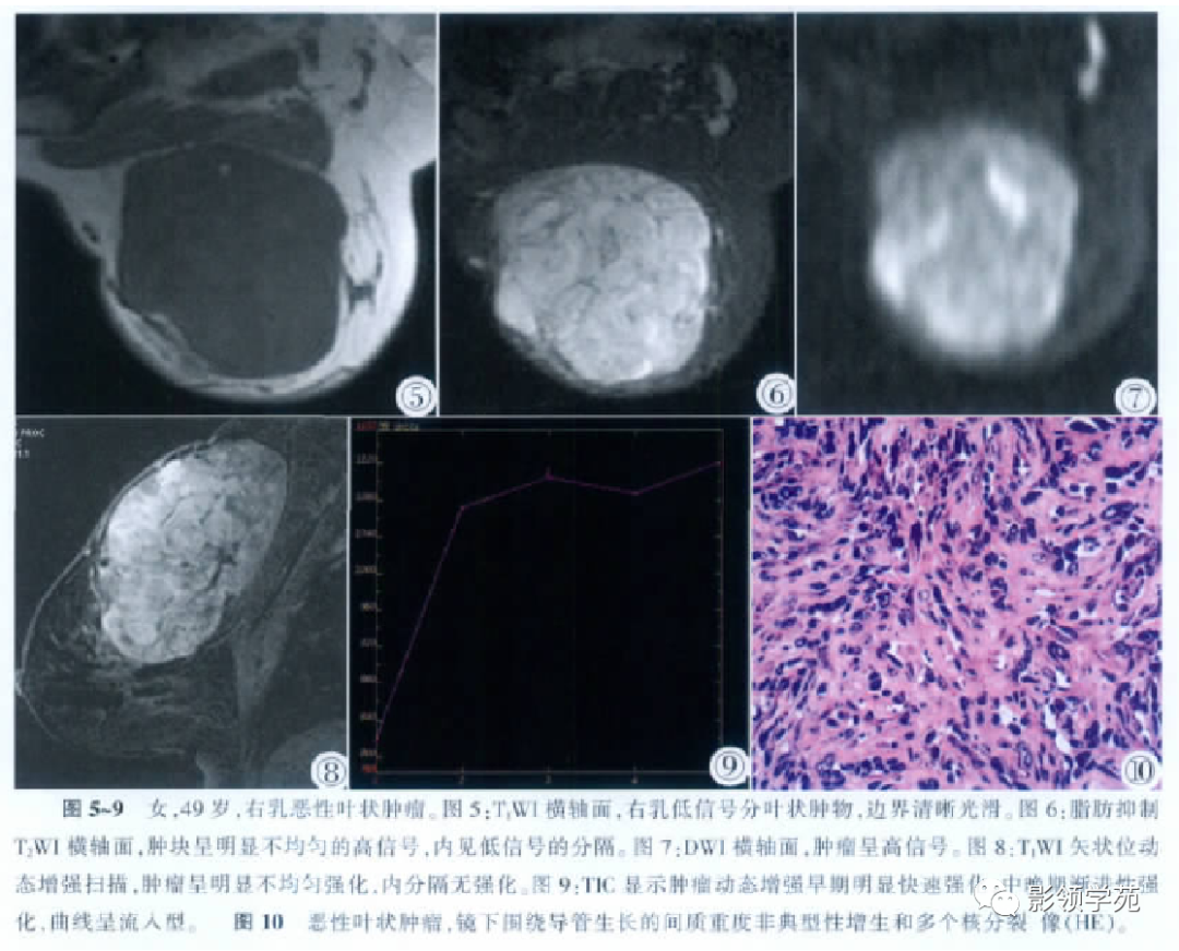 从基础到实践：乳腺常见良性肿瘤及肿瘤样变影像诊断