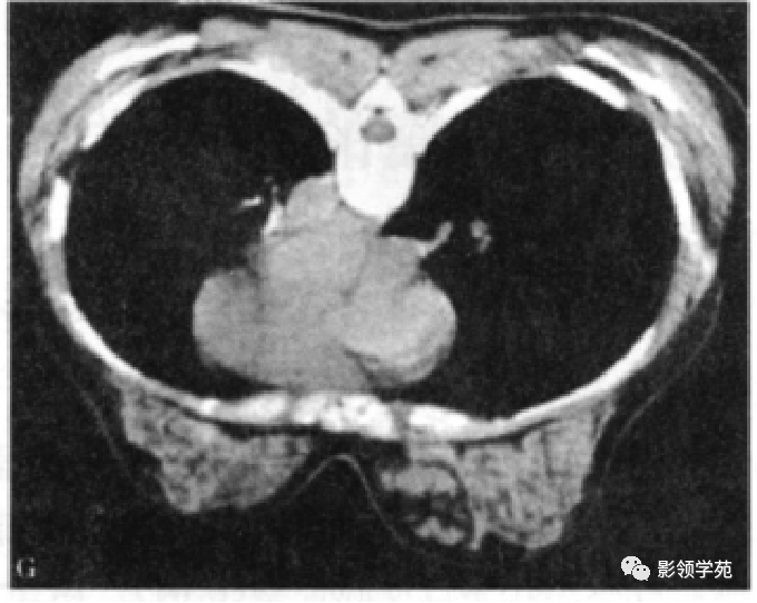 从基础到实践：乳腺常见良性肿瘤及肿瘤样变影像诊断