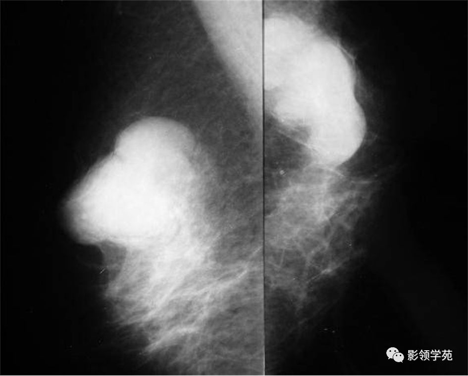 从基础到实践：乳腺常见良性肿瘤及肿瘤样变影像诊断