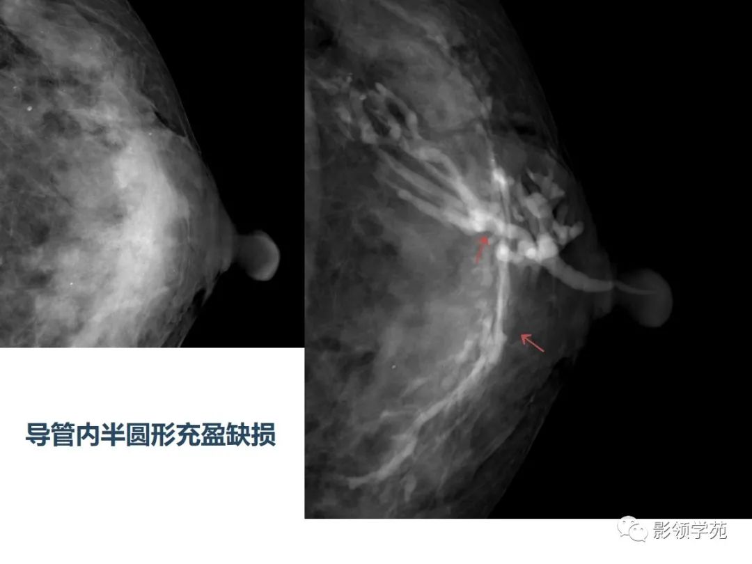 从基础到实践：乳腺常见良性肿瘤及肿瘤样变影像诊断