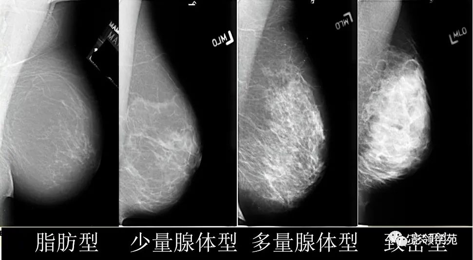 从基础到实践：乳腺常见良性肿瘤及肿瘤样变影像诊断