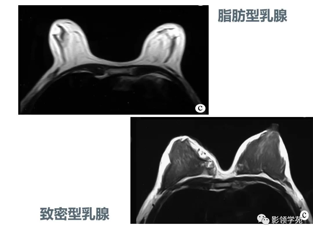 从基础到实践：乳腺常见良性肿瘤及肿瘤样变影像诊断