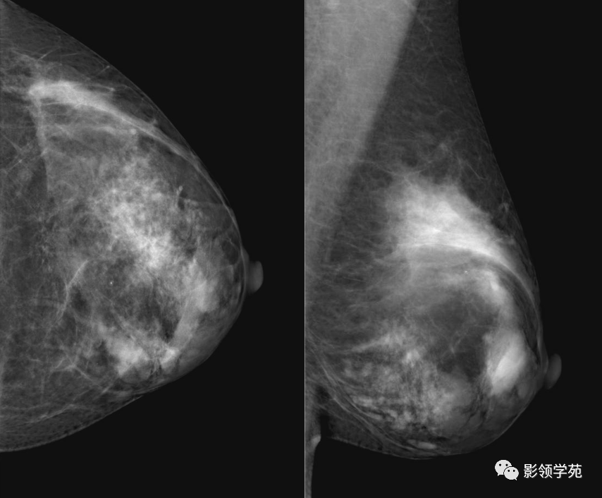 从基础到实践：乳腺常见良性肿瘤及肿瘤样变影像诊断