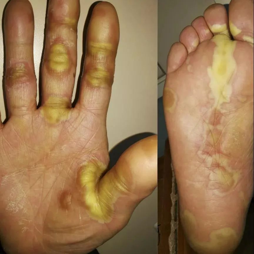 关于靶向、免疫治疗，这些皮肤病如何处理？