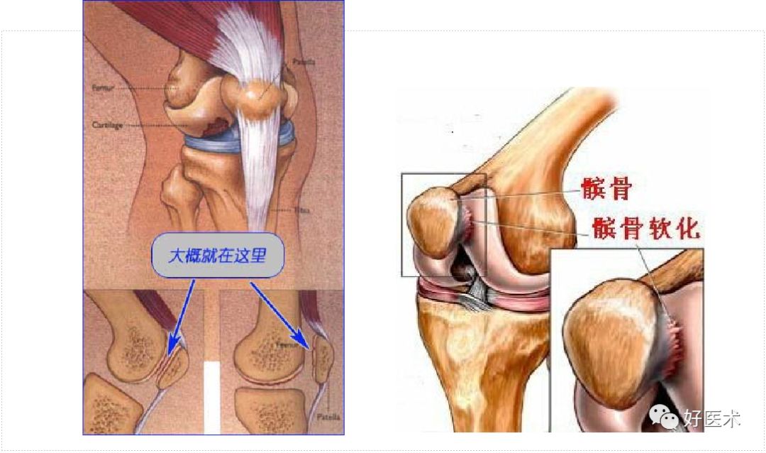上下楼膝前疼痛最常见的原因，没有你想的那么简单！