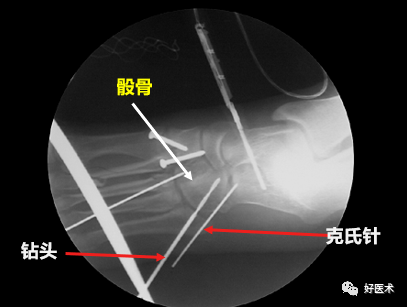 骨科必看：极易漏诊的Lisfranc损伤诊疗关键，本文为你全面解析！