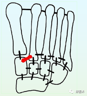 骨科必看：极易漏诊的Lisfranc损伤诊疗关键，本文为你全面解析！