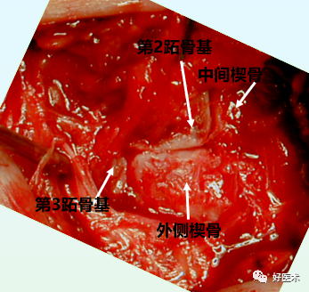 骨科必看：极易漏诊的Lisfranc损伤诊疗关键，本文为你全面解析！