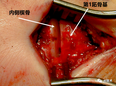 骨科必看：极易漏诊的Lisfranc损伤诊疗关键，本文为你全面解析！