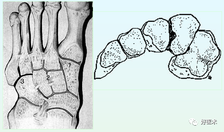 骨科必看：极易漏诊的Lisfranc损伤诊疗关键，本文为你全面解析！