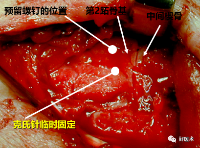 骨科必看：极易漏诊的Lisfranc损伤诊疗关键，本文为你全面解析！