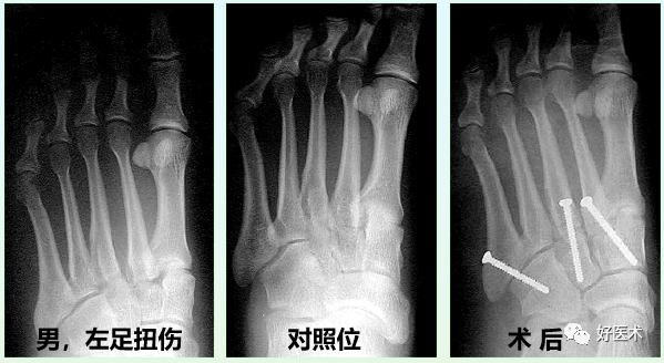 骨科必看：极易漏诊的Lisfranc损伤诊疗关键，本文为你全面解析！