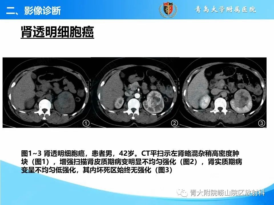 实性肾细胞癌：这些鉴别诊断很重要！