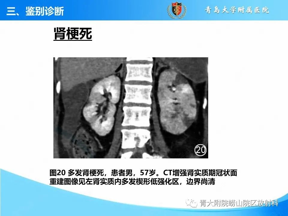实性肾细胞癌：这些鉴别诊断很重要！