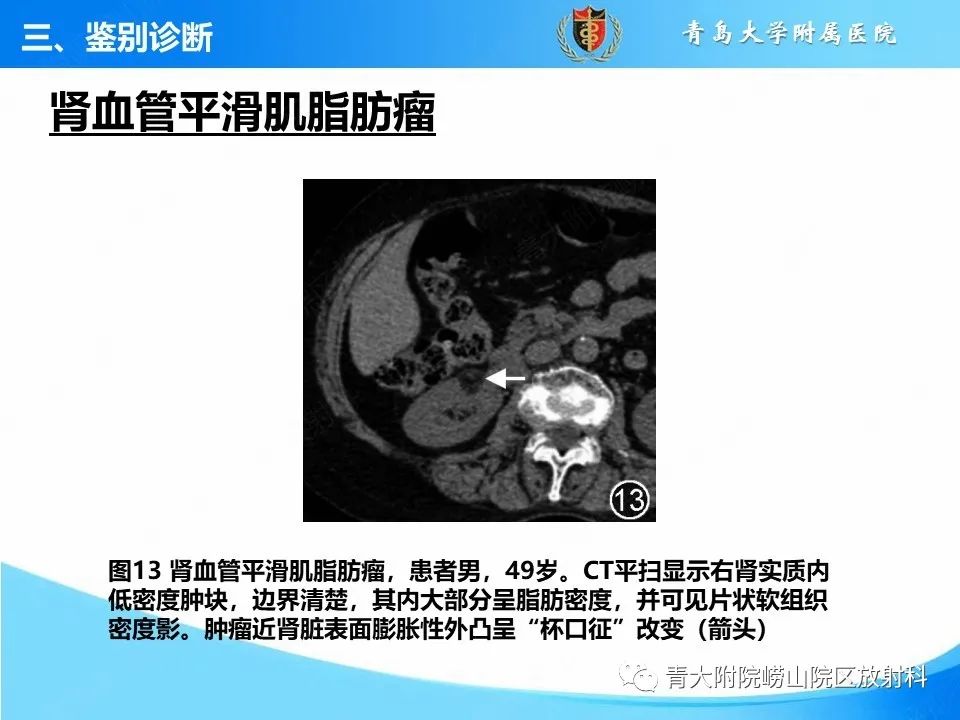 实性肾细胞癌：这些鉴别诊断很重要！