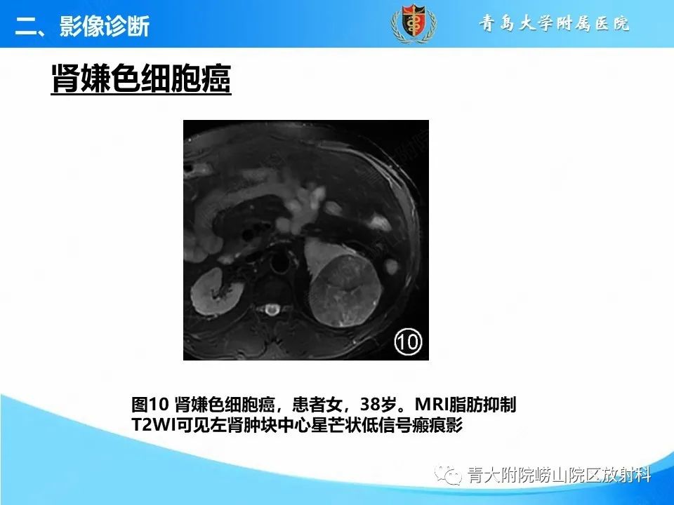 实性肾细胞癌：这些鉴别诊断很重要！