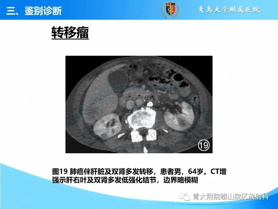 实性肾细胞癌：这些鉴别诊断很重要！