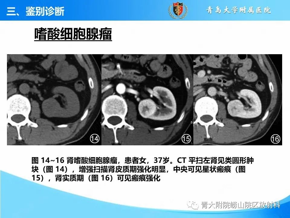 实性肾细胞癌：这些鉴别诊断很重要！