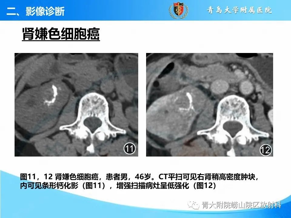 实性肾细胞癌：这些鉴别诊断很重要！