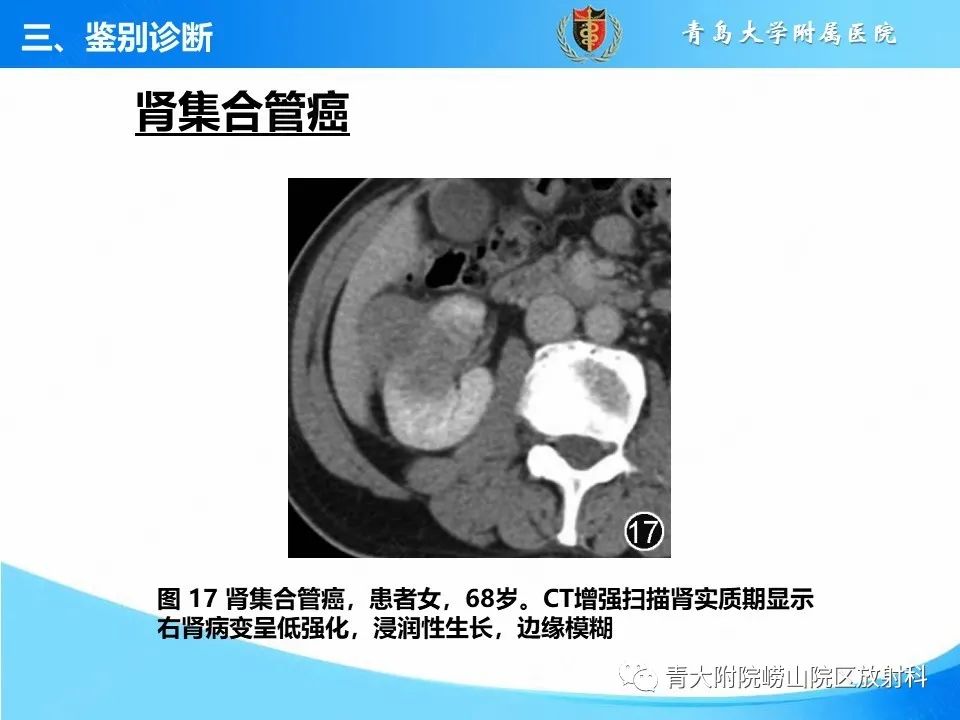 实性肾细胞癌：这些鉴别诊断很重要！