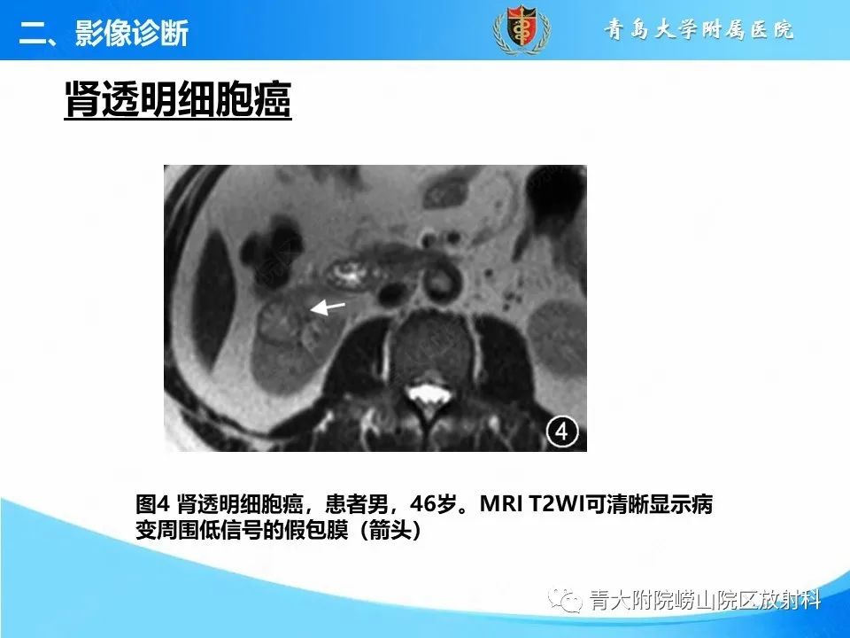 实性肾细胞癌：这些鉴别诊断很重要！