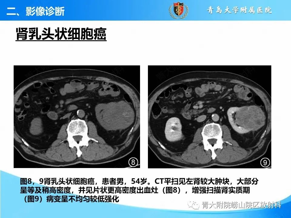 实性肾细胞癌：这些鉴别诊断很重要！