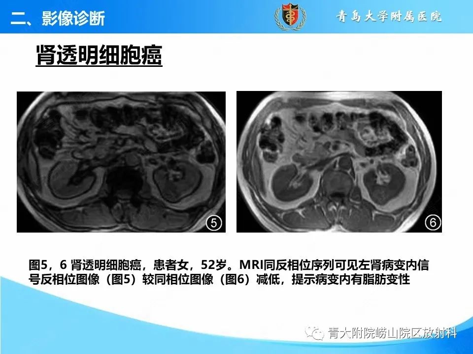 实性肾细胞癌：这些鉴别诊断很重要！