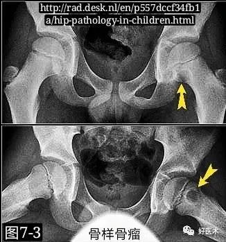 儿童突发髋膝疼痛、跛行，需警惕这个部位的滑膜炎！