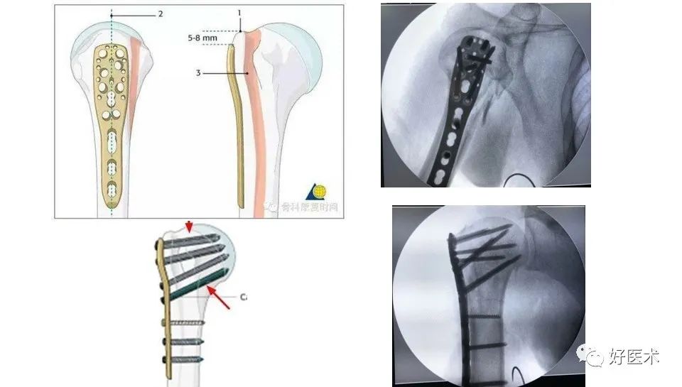 肱骨近端骨折内固定手术技巧，图文记录详细解析！