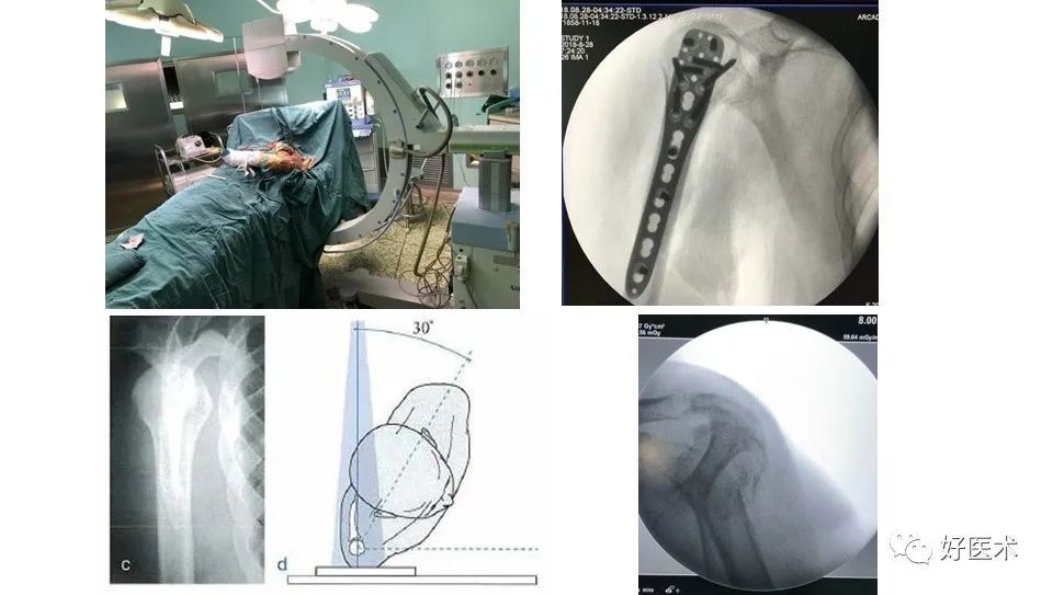 肱骨近端骨折内固定手术技巧，图文记录详细解析！
