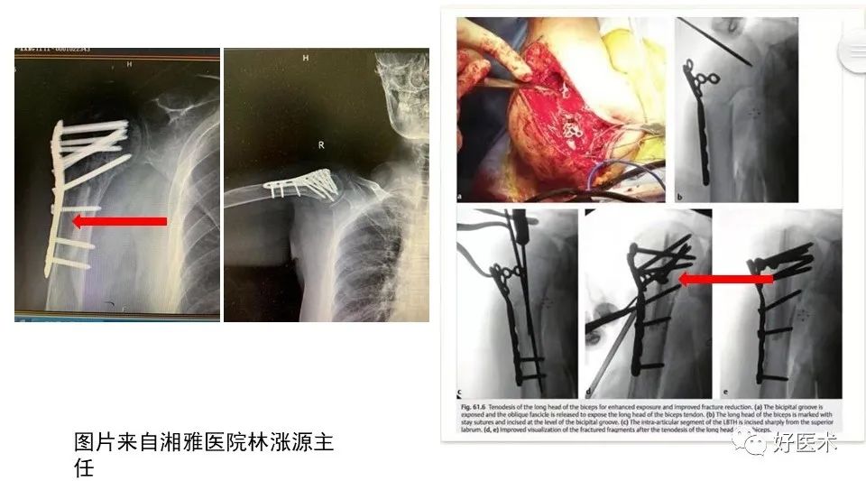 肱骨近端骨折内固定手术技巧，图文记录详细解析！