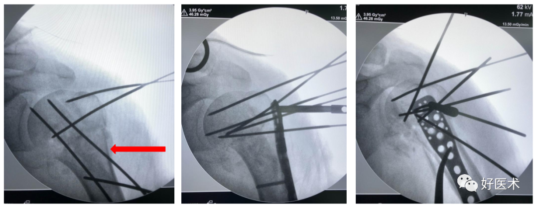 肱骨近端骨折内固定手术技巧，图文记录详细解析！
