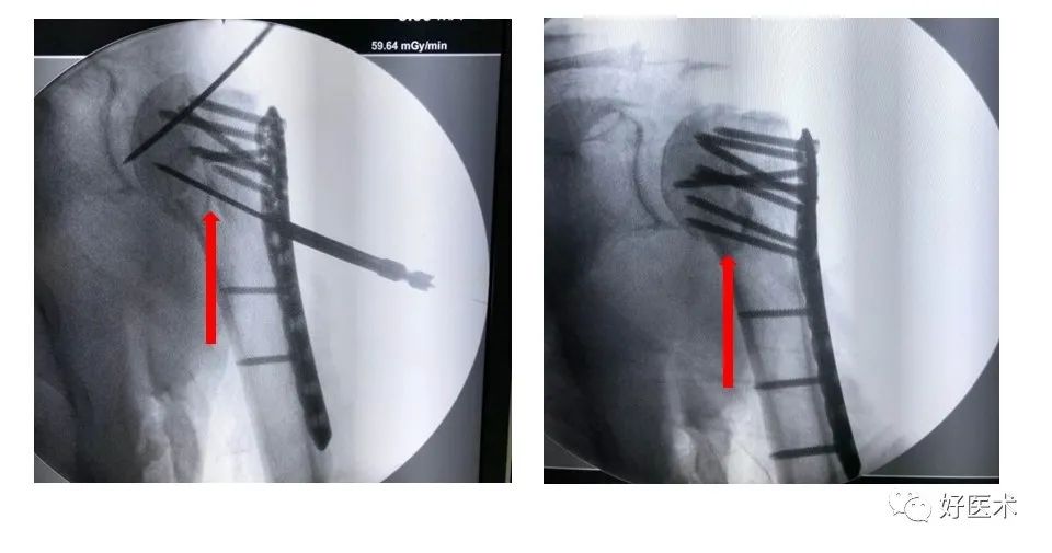 肱骨近端骨折内固定手术技巧，图文记录详细解析！
