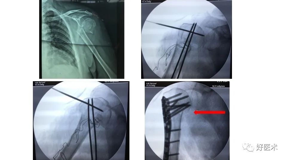 肱骨近端骨折内固定手术技巧，图文记录详细解析！