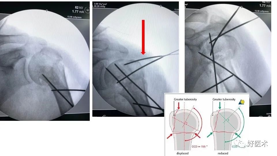肱骨近端骨折内固定手术技巧，图文记录详细解析！