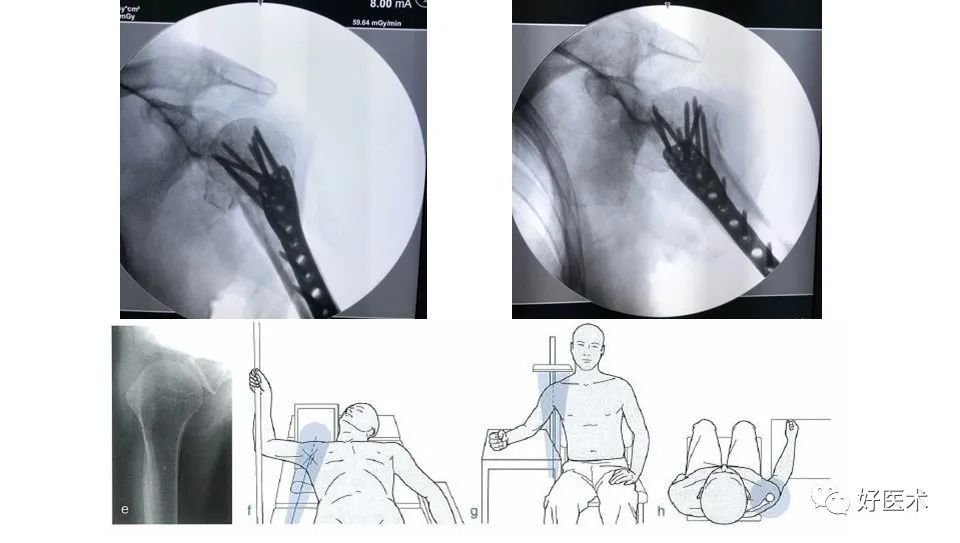 肱骨近端骨折内固定手术技巧，图文记录详细解析！