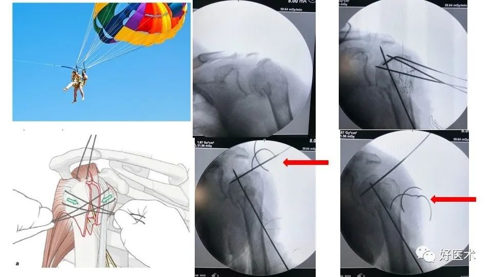 肱骨近端骨折内固定手术技巧，图文记录详细解析！