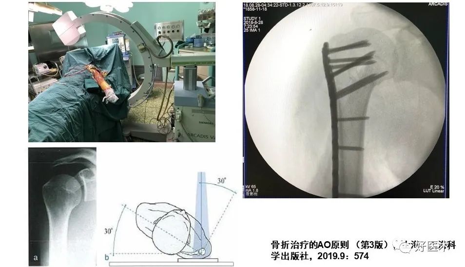 肱骨近端骨折内固定手术技巧，图文记录详细解析！