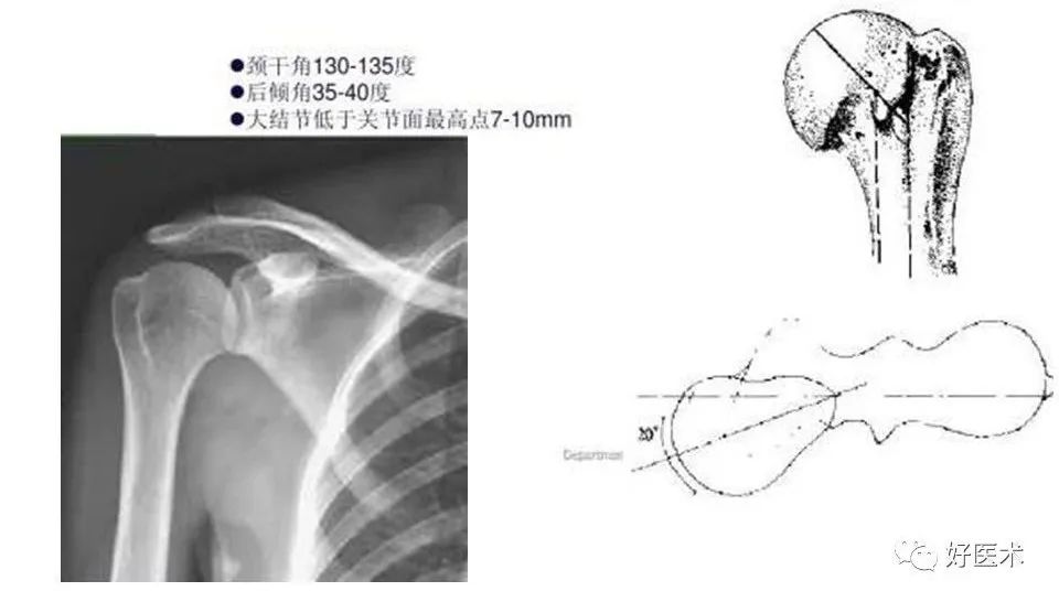 肱骨近端骨折内固定手术技巧，图文记录详细解析！