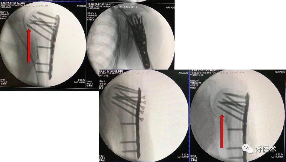 肱骨近端骨折内固定手术技巧，图文记录详细解析！