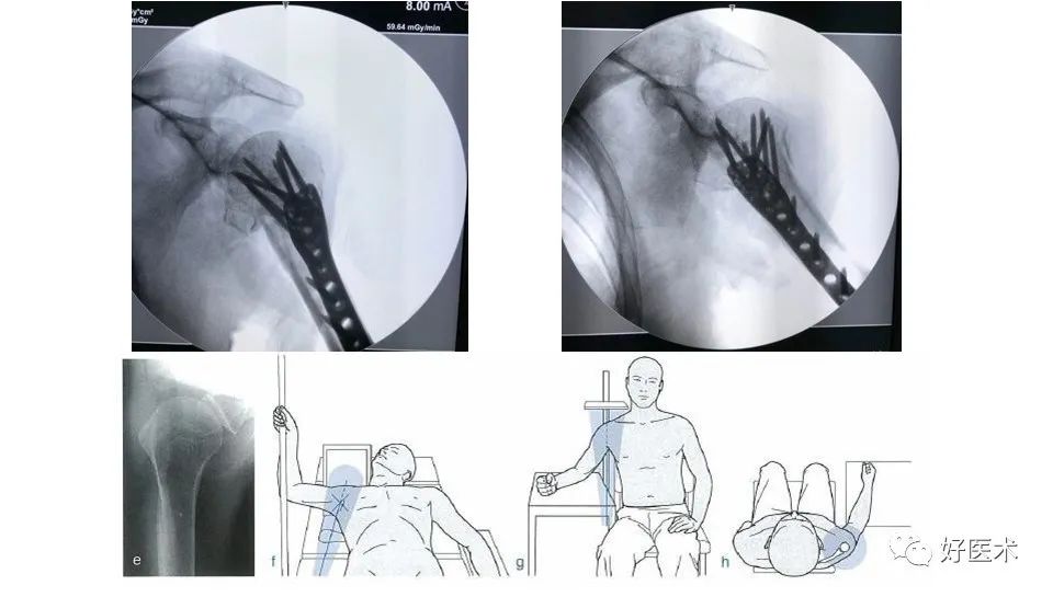 肱骨近端骨折内固定手术技巧，图文记录详细解析！