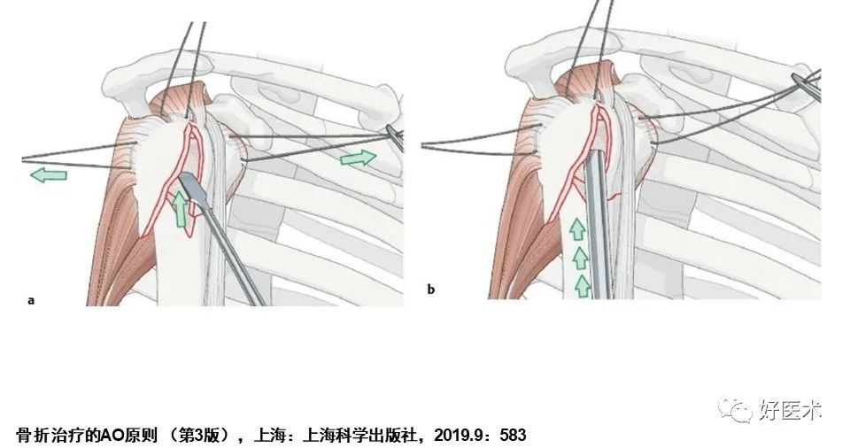 肱骨近端骨折内固定手术技巧，图文记录详细解析！