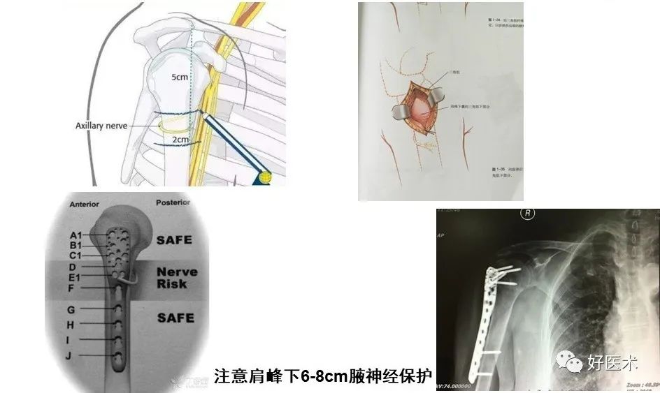 肱骨近端骨折内固定手术技巧，图文记录详细解析！