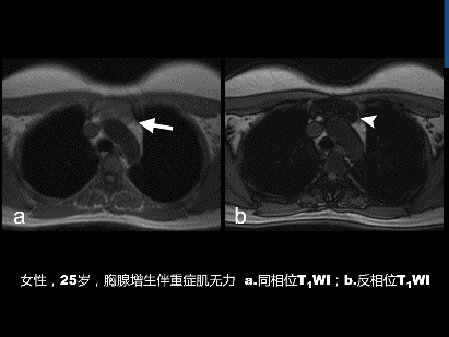 图文解说胸腺瘤，手术要点是...?