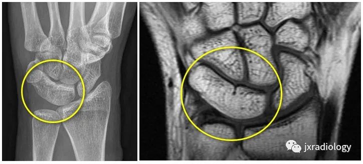 非创伤性腕关节疼痛MRI解读，本文告诉你详细答案！