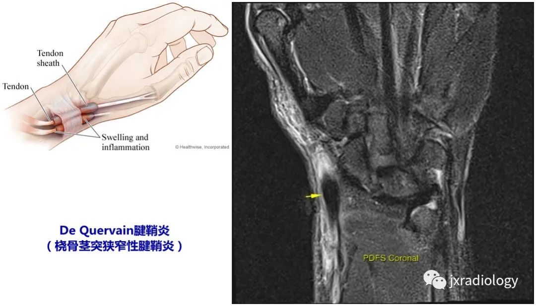 非创伤性腕关节疼痛MRI解读，本文告诉你详细答案！