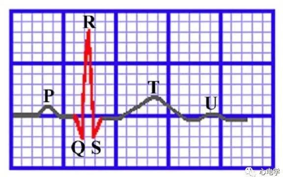 心电图出现Q波，本文解决你90%的难题！