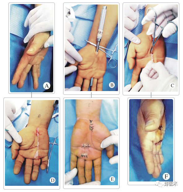 做好掌腱膜挛缩的治疗，手把手教程荐读！